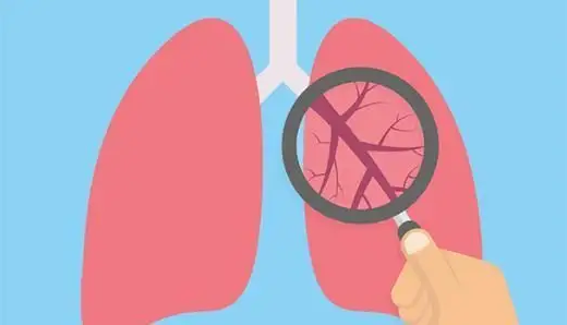 【技术应用】呼吸与危重症医学科：成功开展肺血管介入栓塞术