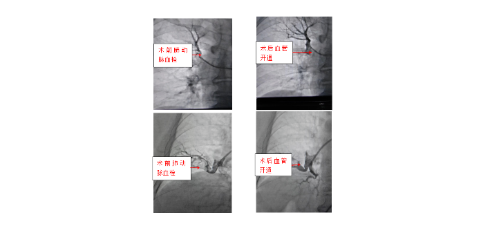 【医院动态】呼吸与危重症医学科：“脑出血”遇“肺栓塞”，利刃出鞘打赢生命守护战