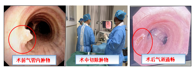 【医院动态】医生巧妙“无痛拆弹” ，让支气管镜诊疗不再恐惧