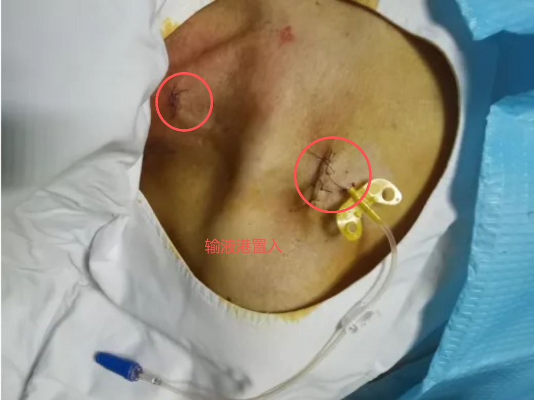 【技术推广】精准置港 守护心脉  心胸外科为长期治疗患者筑起安全港